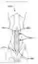 Fig. 01 - BIOABSORBABLE MULTILAYER NASAL VALVE SPREADER GRAFT