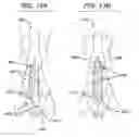 Fig. 16 - BIOABSORBABLE MULTILAYER NASAL VALVE SPREADER GRAFT