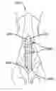 Fig. 01 - BIOABSORBABLE MULTILAYER NASAL VALVE SPREADER GRAFT