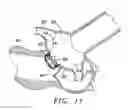 Fig. 10 - Methods and apparatus for percutaneous aortic valve replacement
