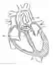 Fig. 01 - Method of treating a patient using a retrievable transcatheter prosthetic heart valve