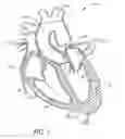 Fig. 02 - Method of treating a patient using a retrievable transcatheter prosthetic heart valve