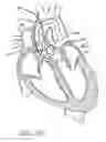 Fig. 29 - Method of treating a patient using a retrievable transcatheter prosthetic heart valve