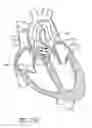 Fig. 30 - Method of treating a patient using a retrievable transcatheter prosthetic heart valve