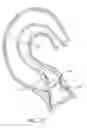Fig. 44 - Method of treating a patient using a retrievable transcatheter prosthetic heart valve
