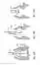 Fig. 71 - Method of treating a patient using a retrievable transcatheter prosthetic heart valve