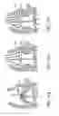Fig. 72 - Method of treating a patient using a retrievable transcatheter prosthetic heart valve