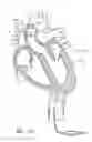 Fig. 78 - Method of treating a patient using a retrievable transcatheter prosthetic heart valve