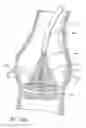 Fig. 79 - Method of treating a patient using a retrievable transcatheter prosthetic heart valve