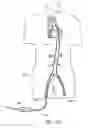 Fig. 85 - Method of treating a patient using a retrievable transcatheter prosthetic heart valve