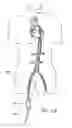 Fig. 86 - Method of treating a patient using a retrievable transcatheter prosthetic heart valve