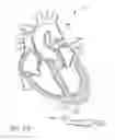 Fig. 87 - Method of treating a patient using a retrievable transcatheter prosthetic heart valve