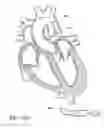 Fig. 88 - Method of treating a patient using a retrievable transcatheter prosthetic heart valve
