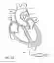 Fig. 89 - Method of treating a patient using a retrievable transcatheter prosthetic heart valve