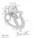 Fig. 90 - Method of treating a patient using a retrievable transcatheter prosthetic heart valve