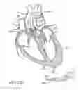 Fig. 91 - Method of treating a patient using a retrievable transcatheter prosthetic heart valve