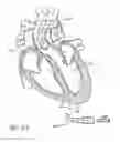 Fig. 93 - Method of treating a patient using a retrievable transcatheter prosthetic heart valve