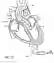 Fig. 94 - Method of treating a patient using a retrievable transcatheter prosthetic heart valve