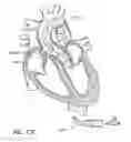 Fig. 95 - Method of treating a patient using a retrievable transcatheter prosthetic heart valve