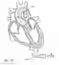 Fig. 96 - Method of treating a patient using a retrievable transcatheter prosthetic heart valve