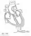 Fig. 97 - Method of treating a patient using a retrievable transcatheter prosthetic heart valve