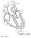Fig. 98 - Method of treating a patient using a retrievable transcatheter prosthetic heart valve