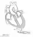 Fig. 99 - Method of treating a patient using a retrievable transcatheter prosthetic heart valve
