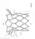 Fig. 06 - Stents with anchoring sections