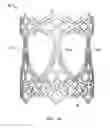 Fig. 02 - Collapsible prosthetic heart valves