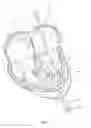 Fig. 03 - Methods for delivery of prosthetic mitral valves