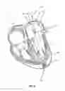 Fig. 04 - Methods for delivery of prosthetic mitral valves
