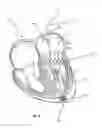 Fig. 05 - Methods for delivery of prosthetic mitral valves