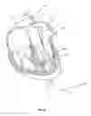 Fig. 09 - Methods for delivery of prosthetic mitral valves