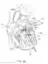 Fig. 29 - Methods for delivery of prosthetic mitral valves