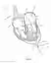 Fig. 43 - Methods for delivery of prosthetic mitral valves