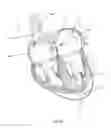 Fig. 45 - Methods for delivery of prosthetic mitral valves