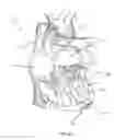 Fig. 48 - Methods for delivery of prosthetic mitral valves