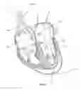 Fig. 50 - Methods for delivery of prosthetic mitral valves