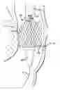 Fig. 01 - Inversion delivery device and method for a prosthesis