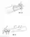 Fig. 03 - Inversion delivery device and method for a prosthesis