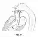 Fig. 16 - Inversion delivery device and method for a prosthesis