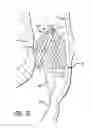 Fig. 19 - Inversion delivery device and method for a prosthesis