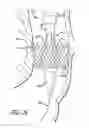 Fig. 20 - Inversion delivery device and method for a prosthesis