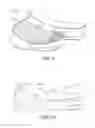Fig. 09 - Prosthesis system including tibial bearing component