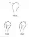 Fig. 17 - Methods, Devices and Techniques for Improved Placement and Fixation of Shoulder Implant Components