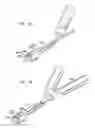 Fig. 76 - Instruments and methods for inserting artificial intervertebral implants