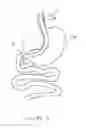 Fig. 02 - Bougie including a light source for performing gastroplasty