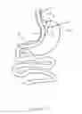 Fig. 03 - Bougie including a light source for performing gastroplasty