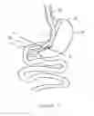 Fig. 04 - Bougie including a light source for performing gastroplasty