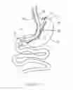 Fig. 05 - Bougie including a light source for performing gastroplasty